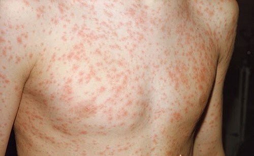 Phát ban là dấu hiệu thường thấy của sốt siêu vi
